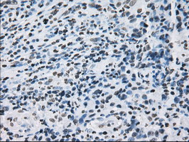 ID3 Antibody - IHC of paraffin-embedded Carcinoma of thyroid tissue using anti-ID3 mouse monoclonal antibody. (Dilution 1:50).