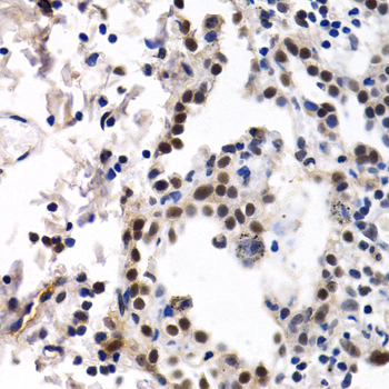 ID3 Antibody - Immunohistochemistry of paraffin-embedded human lung cancer tissue.