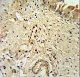 ID4 Antibody - ID4 Antibody IHC of formalin-fixed and paraffin-embedded bladder carcinoma followed by peroxidase-conjugated secondary antibody and DAB staining.