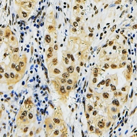 ID4 Antibody - Immunohistochemical analysis of ID4 staining in human lung cancer formalin fixed paraffin embedded tissue section. The section was pre-treated using heat mediated antigen retrieval with sodium citrate buffer (pH 6.0). The section was then incubated with the antibody at room temperature and detected with HRP and DAB as chromogen. The section was then counterstained with hematoxylin and mounted with DPX.