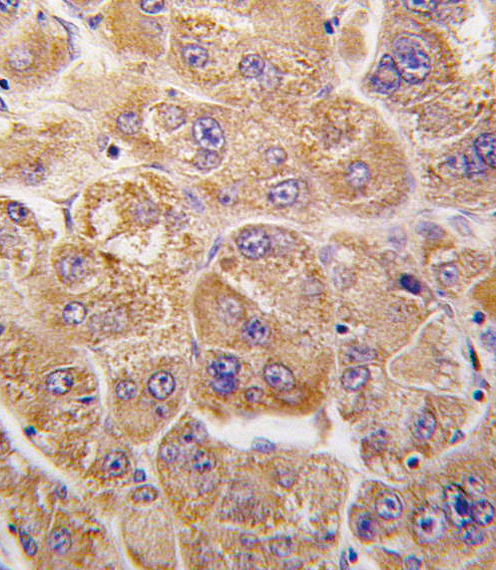 IDE Antibody - Formalin-fixed and paraffin-embedded human hepatocarcinoma tissue reacted with IDE antibody , which was peroxidase-conjugated to the secondary antibody, followed by DAB staining. This data demonstrates the use of this antibody for immunohistochemistry; clinical relevance has not been evaluated.
