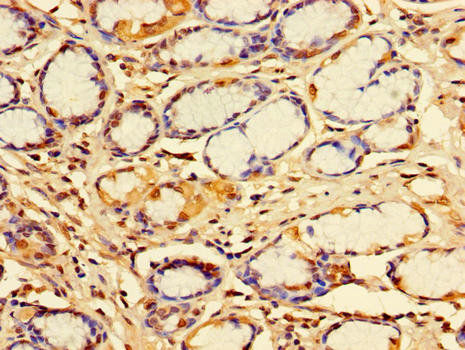 IDE Antibody - Immunohistochemistry of paraffin-embedded human gastric cancer using IDE Antibody at dilution of 1:100