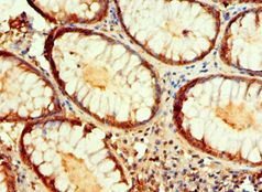 IDH1 / IDH Antibody - Immunohistochemistry of paraffin-embedded human colon cancer using antibody at 1:100 dilution.