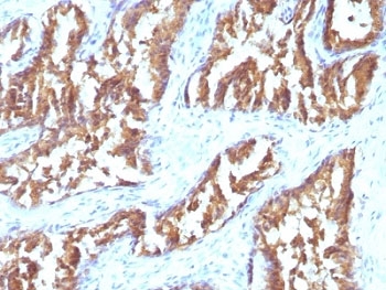 IDH1 / IDH Antibody - Formalin-fixed, paraffin-embedded human prostate carcinoma stained with IDH1 antibody (IDH1/1152).  This image was taken for the unmodified form of this product. Other forms have not been tested.