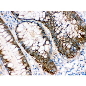 IDH1 / IDH Antibody - IDH1 antibody IHC-paraffin. IHC(P): Human Intestinal Cancer Tissue.