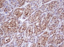 IDH1 / IDH Antibody - IHC of paraffin-embedded Carcinoma of Human thyroid tissue using anti-IDH1 mouse monoclonal antibody. (Heat-induced epitope retrieval by 10mM citric buffer, pH6.0, 100C for 10min).
