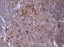 IDH1 / IDH Antibody - IHC of paraffin-embedded Human lymphoma tissue using anti-IDH1 mouse monoclonal antibody.