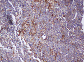 IDH1 / IDH Antibody - IHC of paraffin-embedded Human lymphoma tissue using anti-IDH1 mouse monoclonal antibody. (Heat-induced epitope retrieval by 10mM citric buffer, pH6.0, 100C for 10min).