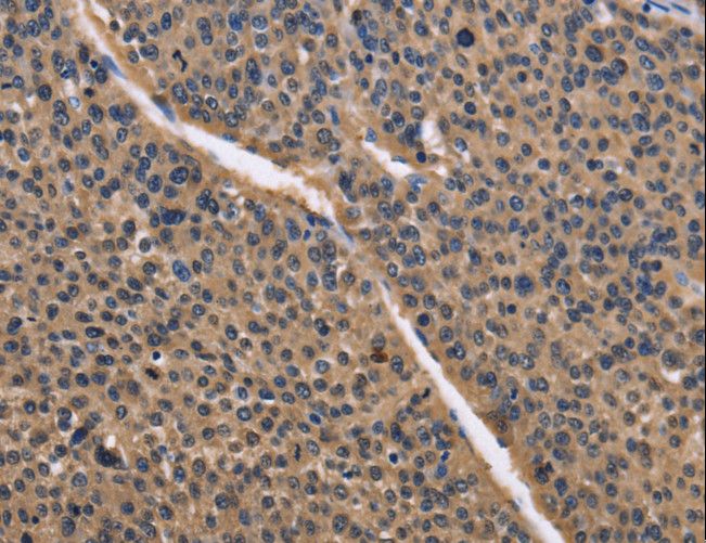 IDH1 / IDH Antibody - Immunohistochemistry of paraffin-embedded Human liver cancer using IDH1 Polyclonal Antibody at dilution of 1:50.