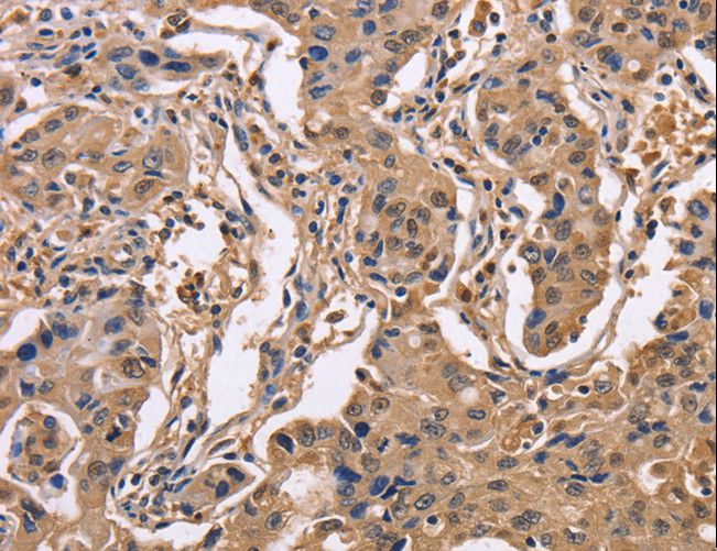 IDH1 / IDH Antibody - Immunohistochemistry of paraffin-embedded Human lung cancer using IDH1 Polyclonal Antibody at dilution of 1:50.