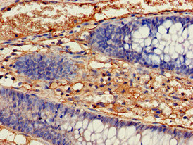 IDH1 / IDH Antibody - Immunohistochemistry of paraffin-embedded human colon cancer at dilution of 1:100