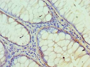 IDH2 Antibody - Immunohistochemistry of paraffin-embedded human breast cancer using antibody at 1:100 dilution.