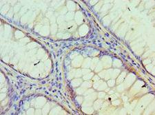 IDH2 Antibody - Immunohistochemistry of paraffin-embedded human breast cancer using antibody at 1:100 dilution.