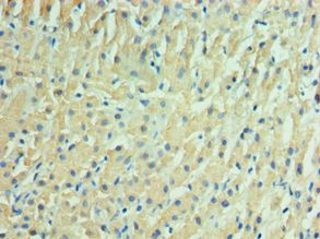 IDH2 Antibody - Immunohistochemistry of paraffin-embedded human liver cancer using antibody at 1:100 dilution.