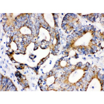 IDH2 Antibody - IDH2 antibody IHC-paraffin. IHC(P): Human Intestinal Cancer Tissue.