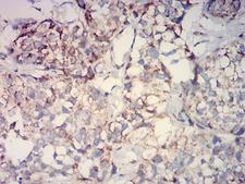 IDH2 Antibody - Immunohistochemical analysis of paraffin-embedded bladder cancer tissues using IDH2 mouse mAb with DAB staining.