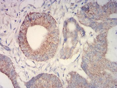 IDH2 Antibody - Immunohistochemical analysis of paraffin-embedded colon cancer tissues using IDH2 mouse mAb with DAB staining.
