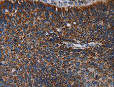 IDH2 Antibody - Immunohistochemistry of paraffin-embedded Human cervical cancer using IDH2 Polyclonal Antibody at dilution of 1:60.