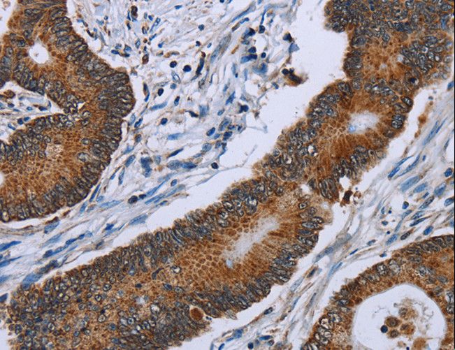 IDH2 Antibody - Immunohistochemistry of paraffin-embedded Human colon cancer using IDH2 Polyclonal Antibody at dilution of 1:60.