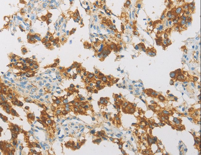 IDH3G Antibody - Immunohistochemistry of paraffin-embedded Human thyroid cancer using IDH3G Polyclonal Antibody at dilution of 1:30.