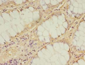 IDI2 Antibody - Immunohistochemistry of paraffin-embedded human breast cancer tissue using antibody at 1:100 dilution.