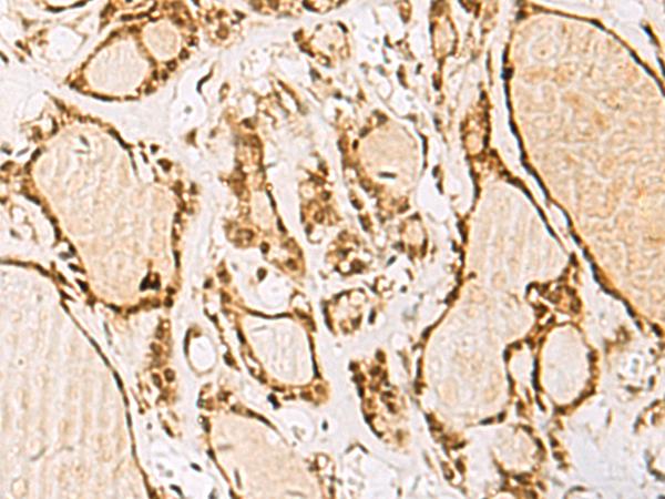 IDN3 / NIPBL Antibody - Immunohistochemistry of paraffin-embedded Human thyroid cancer tissue  using NIPBL Polyclonal Antibody at dilution of 1:55(×200)