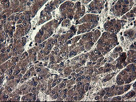 IDO1 / IDO Antibody - IHC of paraffin-embedded Carcinoma of Human liver tissue using anti-IDO1 mouse monoclonal antibody.