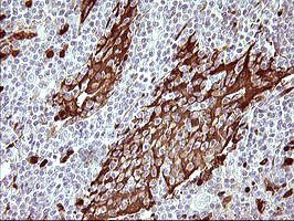 IDO1 / IDO Antibody - IHC of paraffin-embedded Human lymphoma tissue using anti-IDO1 mouse monoclonal antibody. (Heat-induced epitope retrieval by 10mM citric buffer, pH6.0, 120°C for 3min).