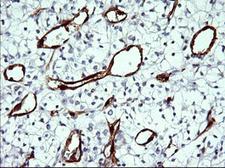 IDO1 / IDO Antibody - IHC of paraffin-embedded Carcinoma of Human kidney tissue using anti-IDO1 mouse monoclonal antibody.