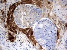 IDO1 / IDO Antibody - Immunohistochemical staining of paraffin-embedded Carcinoma of Human lung tissue using anti-IDO1 mouse monoclonal antibody.  heat-induced epitope retrieval by 10mM citric buffer, pH6.0, 120C for 3min)