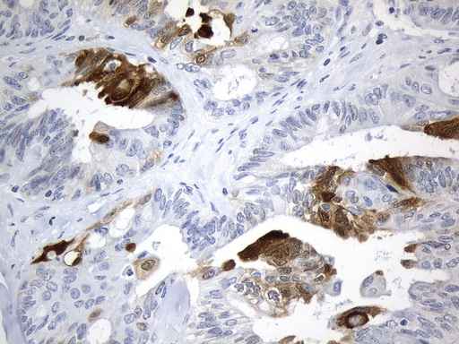 IDO1 / IDO Antibody - Immunohistochemical staining of paraffin-embedded Adenocarcinoma of Human ovary tissue using anti-IDO1 mouse monoclonal antibody. (Heat-induced epitope retrieval by 1mM EDTA in 10mM Tris buffer. (pH8.0) at 120°C for 2.5 min. (1:600)