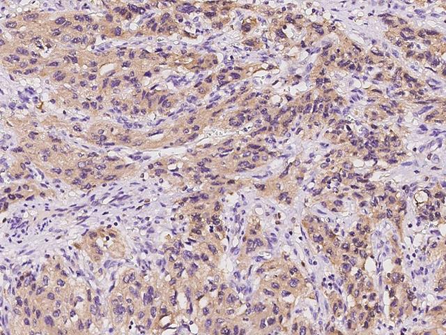 IDO1 / IDO Antibody - Immunochemical staining of human IDO1 in human renal carcinoma with rabbit polyclonal antibody at 1:1000 dilution, formalin-fixed paraffin embedded sections.