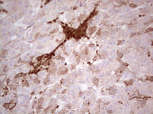 IDO2 / INDOL1 Antibody - Immunohistochemical staining of paraffin-embedded Carcinoma of Human liver tissue using anti-IDO2 mouse monoclonal antibody. (Heat-induced epitope retrieval by 1 mM EDTA in 10mM Tris, pH8.5, 120C for 3min,