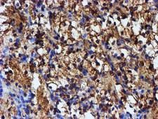 IDS / Iduronate 2 Sulfatase Antibody - IHC of paraffin-embedded Carcinoma of Human kidney tissue using anti-IDS mouse monoclonal antibody.
