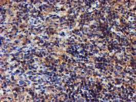 IDS / Iduronate 2 Sulfatase Antibody - IHC of paraffin-embedded Human lymphoma tissue using anti-IDS mouse monoclonal antibody.