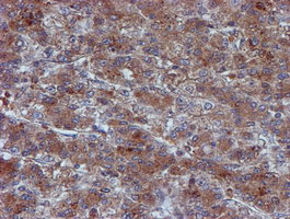 IDS / Iduronate 2 Sulfatase Antibody - IHC of paraffin-embedded Carcinoma of Human liver tissue using anti-IDS mouse monoclonal antibody.