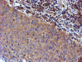 IDS / Iduronate 2 Sulfatase Antibody - IHC of paraffin-embedded Carcinoma of Human bladder tissue using anti-IDS mouse monoclonal antibody.