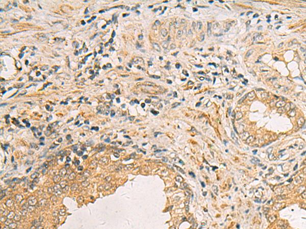 IDS / Iduronate 2 Sulfatase Antibody - Immunohistochemistry of paraffin-embedded Human prost ate cancer tissue  using IDS Polyclonal Antibody at dilution of 1:70(×200)