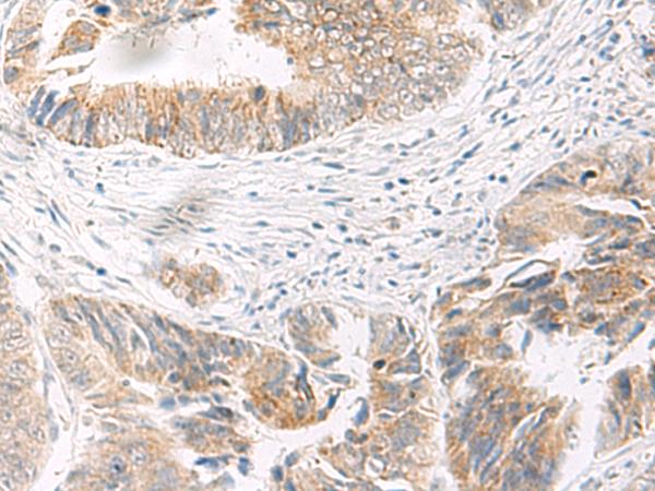 IDUA / MPS1 Antibody - Immunohistochemistry of paraffin-embedded Human colorectal cancer tissue  using IDUA Polyclonal Antibody at dilution of 1:35(×200)