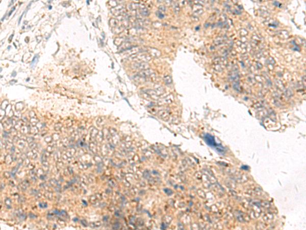 IDUA / MPS1 Antibody - Immunohistochemistry of paraffin-embedded Human tonsil tissue  using IDUA Polyclonal Antibody at dilution of 1:30(×200)