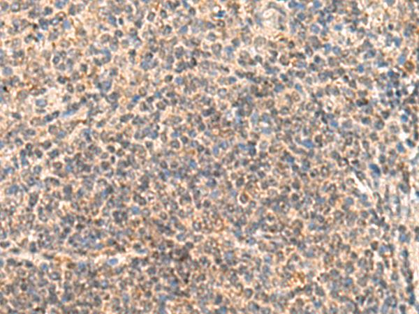 IDUA / MPS1 Antibody - Immunohistochemistry of paraffin-embedded Human colorectal cancer tissue  using IDUA Polyclonal Antibody at dilution of 1:30(×200)
