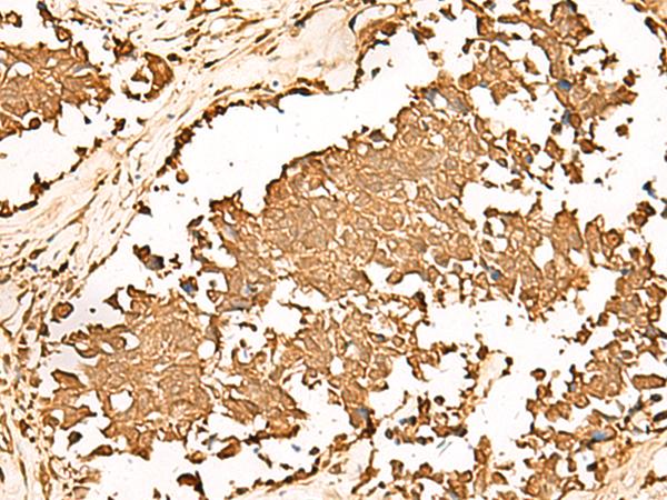 IEF-SSP-9502 / PWP1 Antibody - Immunohistochemistry of paraffin-embedded Human lung cancer tissue  using PWP1 Polyclonal Antibody at dilution of 1:70(×200)