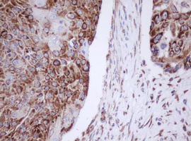 IF3mt / MTIF3 Antibody - IHC of paraffin-embedded Carcinoma of Human lung tissue using anti-MTIF3 mouse monoclonal antibody. (Heat-induced epitope retrieval by 10mM citric buffer, pH6.0, 100C for 10min).