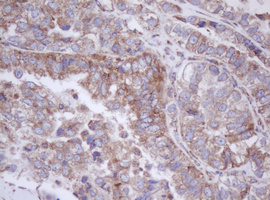 IF3mt / MTIF3 Antibody - IHC of paraffin-embedded Adenocarcinoma of Human ovary tissue using anti-MTIF3 mouse monoclonal antibody. (Heat-induced epitope retrieval by 10mM citric buffer, pH6.0, 100C for 10min).