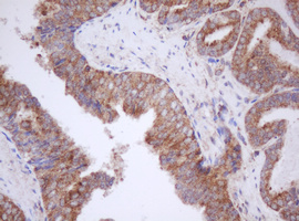 IF3mt / MTIF3 Antibody - IHC of paraffin-embedded Carcinoma of Human prostate tissue using anti-MTIF3 mouse monoclonal antibody. (Heat-induced epitope retrieval by 10mM citric buffer, pH6.0, 100C for 10min).