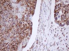 IF3mt / MTIF3 Antibody - IHC of paraffin-embedded Carcinoma of Human lung tissue using anti-MTIF3 mouse monoclonal antibody. (Heat-induced epitope retrieval by 10mM citric buffer, pH6.0, 100C for 10min).