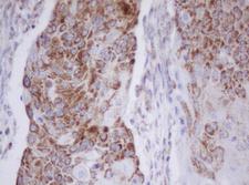 IF3mt / MTIF3 Antibody - IHC of paraffin-embedded Carcinoma of Human lung tissue using anti-MTIF3 mouse monoclonal antibody.