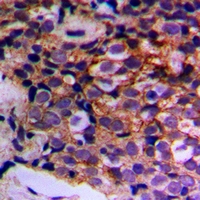 IF3mt / MTIF3 Antibody - Immunohistochemical analysis of MTIF3 staining in human prostate cancer formalin fixed paraffin embedded tissue section. The section was pre-treated using heat mediated antigen retrieval with sodium citrate buffer (pH 6.0). The section was then incubated with the antibody at room temperature and detected with HRP and DAB as chromogen. The section was then counterstained with hematoxylin and mounted with DPX.