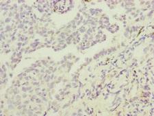 IF3mt / MTIF3 Antibody - Immunohistochemistry of paraffin-embedded human lung cancer at dilution of 1:100