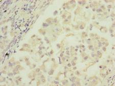 IF3mt / MTIF3 Antibody - Immunohistochemistry of paraffin-embedded human lung cancer at dilution of 1:100